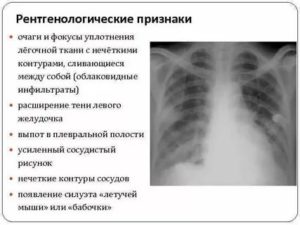 Очаги уплотнения легочной ткани округлой формы