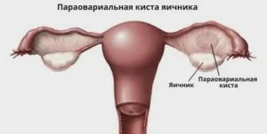 Параовариальная киста и гидросальпинкс