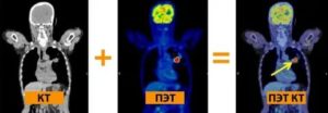 Результат ПЭТКТ солидное образование в легких что это?