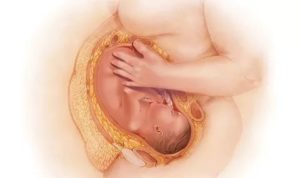 Беременность, тонус матки, отмена утрожестана