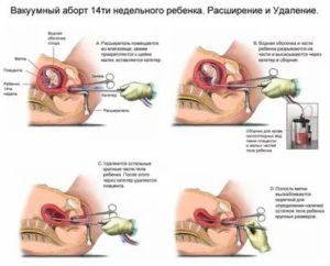 Набрала вес в районе живота после аборта