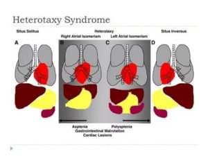 Синдром гетеротаксии