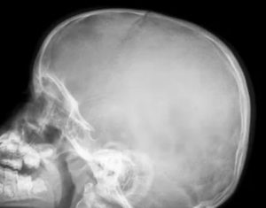 Рентген головы ребенка