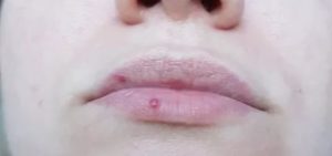Красная точка на губе