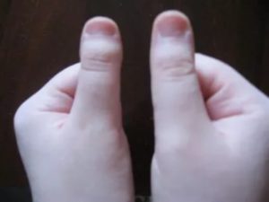 Удлинение фаланги большого пальца руки