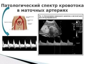 Повышен кровоток в правой маточной артерии