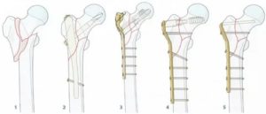 Остеосинтез шейки бедра