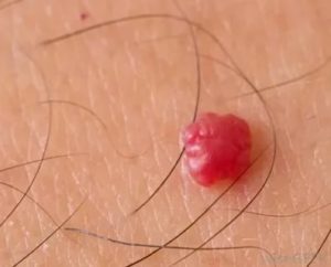 Болезненное образование на половой губе