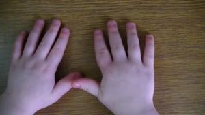 Отекают пальцы у ребёнка