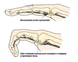 Боль в указательно пальце правой руки