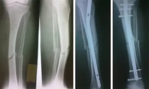 Реабилитация после перелома большой берцовой кости