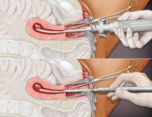 Боли после вакуумной чистке