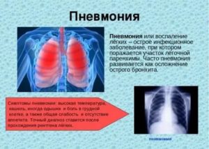 После пневмонии снова кашель