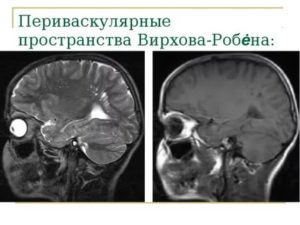 Периваскулярные пространства