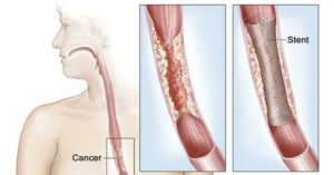 Рак жедудка и последствия стентирования