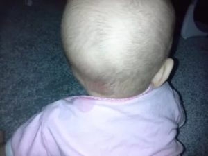 Шишка выпячивает над родничком