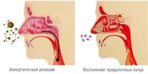 Сопли при задней стенке+бронхит