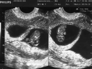 Ретрохориальная гематома. Срок беременности 4-5 недель