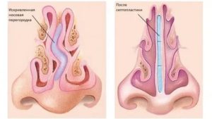 Септопластика и Вазотомия