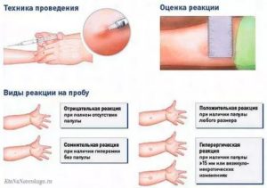 Результат пробы манту сомнительный?