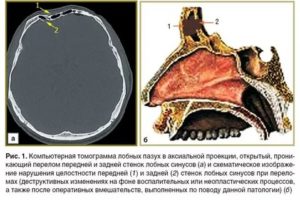 Перелом лобной пазухи