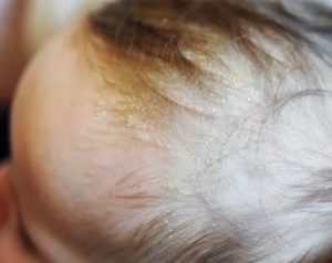Шелушение кожи головы ребёнка