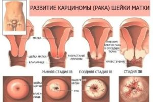 Кондиломы и воспаление шейки матки
