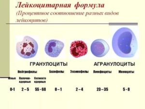 Увеличение общих лейкоцитов в крови без изменения лейкоцитарной формулы