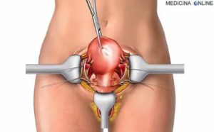 Боли после удаления придатков