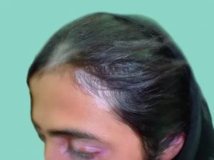 Белый клок волос на голове