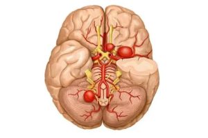 Аневризма головного мозга
