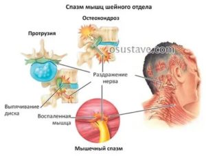 Шейный остехандроз ком в горле тянет горло немеют руки