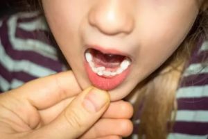 Коренной зуб вырос сзади молочного