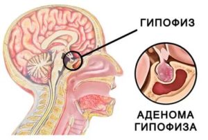 Аденома гипофиза