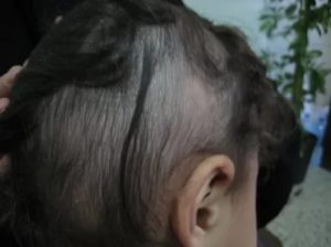От чего могут выпадать у дочки волосы?