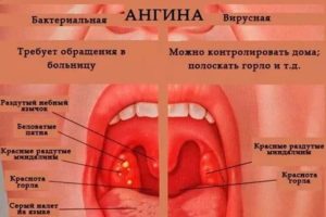 Месяц болит горло без температуры и красного горла