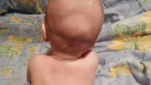 Шишка выпячивает над родничком