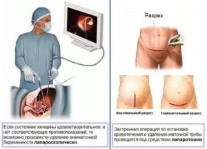 Беременность после удаления маточной трубы