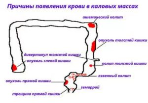 Боль, кровь на бумаге и в кале