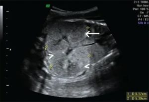2-ая беременность при врождённом поликистозе почек