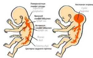 Кистозная гигрома шеи плода