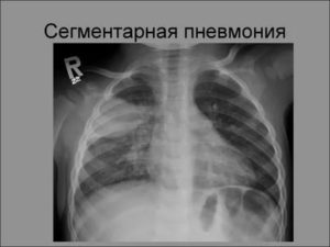 Сегментарная пневмония у ребенка