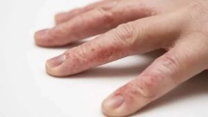 Аллергия на пальцах рук