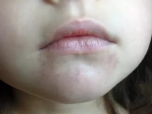 У ребенка 8 лет пятна вокруг губ, похожие на кровоизлияние