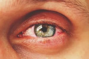 Красные глаз после лечения конъюнктивита