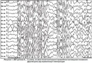 Расшифровка ЭЭГ в динамике