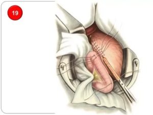 Операция 12 перстной кишки удалили часть кишечника