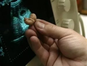 Беременность через месяц после аборта