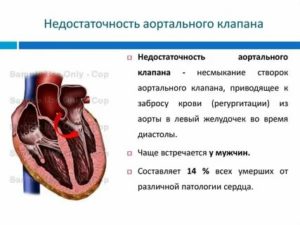 Недостаточность аортального клапана: фиброз створок, регургитация до 2-3 степени