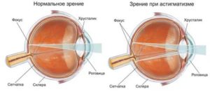 Астигматизм и спорт